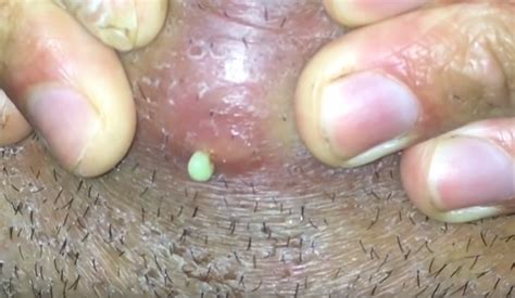 It can happen when pubic hair has been shaved, waxed, or plucked. ingrown hair turned into hard lump under skin | New Pimple ...