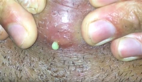 Yes, we're talking about ingrown hairs. ingrown hair turned into hard lump under skin | New Pimple ...