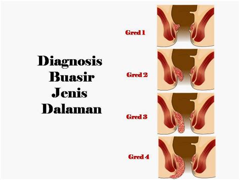 Buasir ini sudah lama, bukannya penyakit yang baru timbul. Merawat buasir dengan berkesan - Jana Hazana