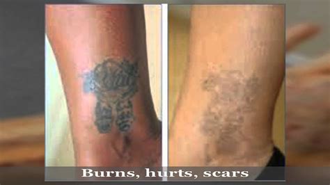 Remove your tattoo for just $47. Tattoo removal Gone Wrong (laser Treatment) - YouTube