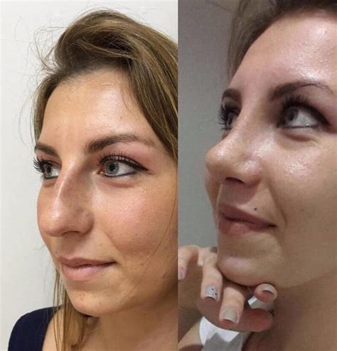 It seems like lately there is increased popularity in apps that make us look fresher and 'better' in our photos. best before and after nose jobs (4) » Rhinoplasty: Cost ...
