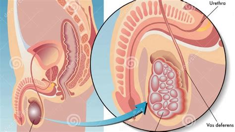 Scrotal swelling is the most common complaint in cases of testicular cancer, and it is always confined to the scrotum. Symptoms And Signs For Testicular Cancer- Do Not Ignore ...