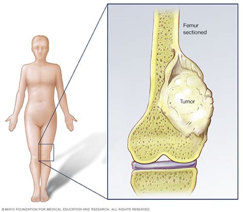 Whether you're curious about what bone cancer feels like in your leg or arm, it's important to know the specifics of the pain, so you can best describe the feeling to your physician. Childhood Bone Cancer | Osteosarcoma | Ewings Sarcoma ...