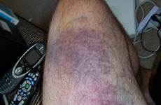bruise thigh update langille dan wed other