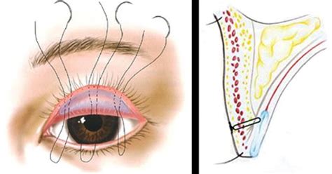 Two of the eyelids (the upper and lower eyelids) have eyelashes. Eyelid Surgery by Prof Dr CN CHUA 蔡鐘能: One of the Many ...