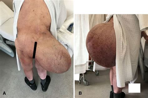 Each mass will cost between $200 to $500 for removal. 20 kg Gluteal Lipoma - MediHelp