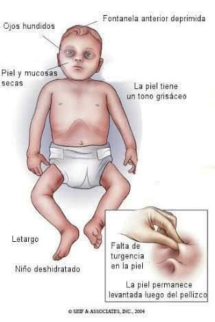 Sepsis & choque septico embarazo. Lo peligroso de una diarrea aguda es... - Robles Pediatric ...