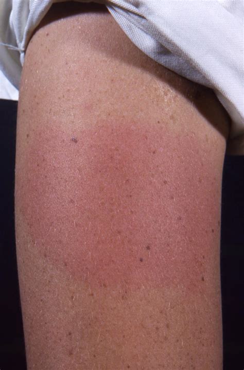 An angry red rash being called covid arm is a harmless but annoying response in some people who get the moderna vaccine. Covid Arm Moderna Melden : COVID Arm: A Rash Sometimes ...