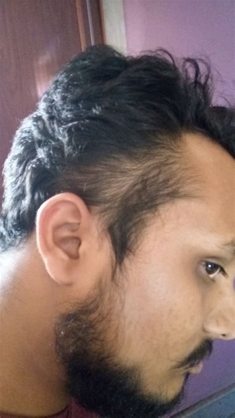 I have been on propecia for about 9 months. Can Male Pattern Baldness Turn Into Dupa Later In Life ...