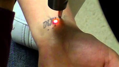 After 11 treatments this tattoo was successfully removed. PicoSure Tattoo Removal Both Wrists - YouTube