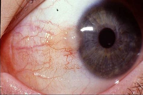 Losing weight is a big red flag that something serious might be going on, as children don't normally lose weight over long periods of time. The Australian Pterygium Centre - Be wise about your ...