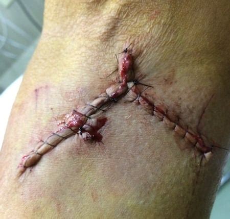 Laceration arm V-Y sutured running | ALiEM