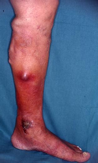 Che tipo di ulcera alle gambe ho? - Ferite difficili ...