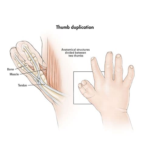 News & world report and is the primary pediatric teaching affiliate of harvard medical school. Thumb duplication (pre-axial polydactyly) | Boston ...