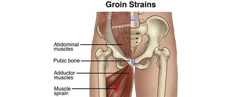 While the last rites of a loved one are understandably a very sentimental issue, here are some of the alternatives. Groin Strain Treatment - California Chiropractic Dubai