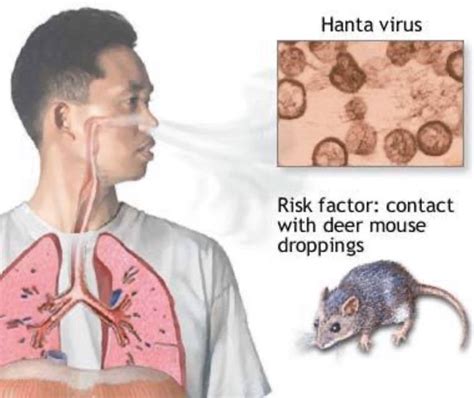 Hantavirus pulmonary syndrome is a severe, sometimes fatal, respiratory infectious disease in humans caused by infection with hantaviruses (part of the hemorrhagic fever virus). hantavirus pulmonary syndrome causes and treatment