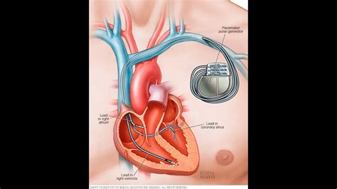Pacemakers are electronic devices that stimulate the heart with electrical impulses to maintain or restore a normal heartbeat. Pacemaker के FUNCTION और सावधानियां - YouTube