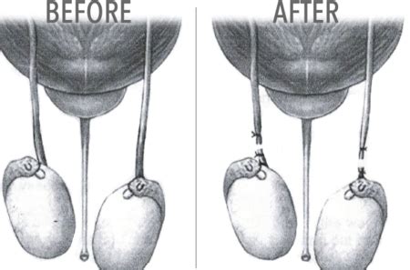 Time procedure of work in making mokimo. Vasectomy