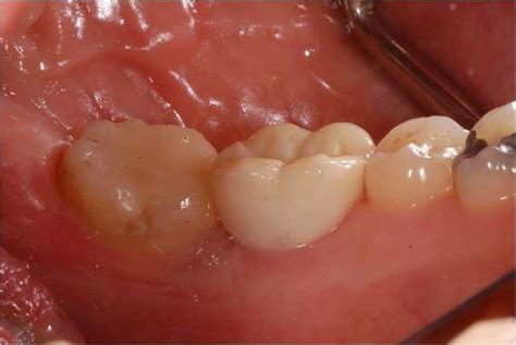 The monolithic material, not veneered with any ceramic layer, shows a less attractive esthetic appearance, but is not affected by. Implant-supported single crown with modified monolithic ...