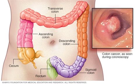 Pappou, a colorectal surgeon at memorial sloan kettering cancer center in new york. Colon cancer - Symptoms and causes - Mayo Clinic