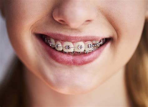 My son is 19 and has bottom teeth that do not nest with the top teeth. Traditional Braces Brooklyn | Orthodontics | Ralph Avenue Dental Care