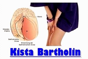 These cysts result from exaggerated physiological stimulation (hyperreactio luteinalis). Cara Menyembuhkan Kista Bartholin Tanpa Operasi