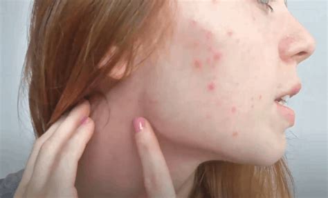 The average time symptoms appear is around 4 to 5 days. Is Skin Rash An Emerging Symptoms Of COVID-19? Know The ...