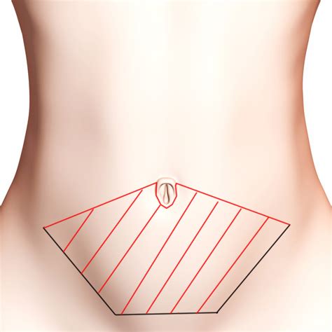 Ici vous trouvez les cliniques de chirurgie esthétique qui effectuent l'abdominoplastie en france et à l'étranger! Abdominoplastie à Bordeaux par le Dr Réau chirurgien ...