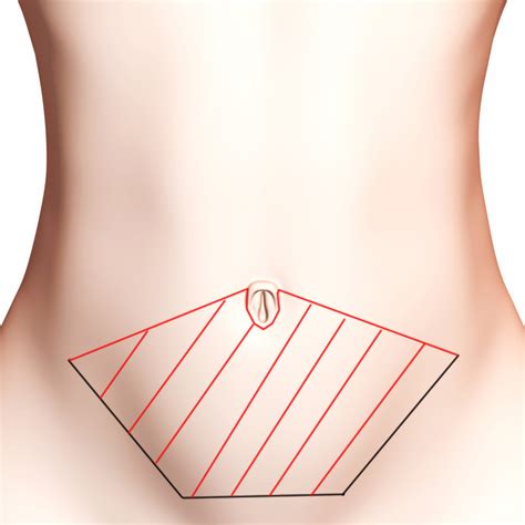 Ici vous trouvez les cliniques de chirurgie esthétique qui effectuent l'abdominoplastie en france et à l'étranger! Abdominoplastie à Bordeaux par le Dr Réau chirurgien ...