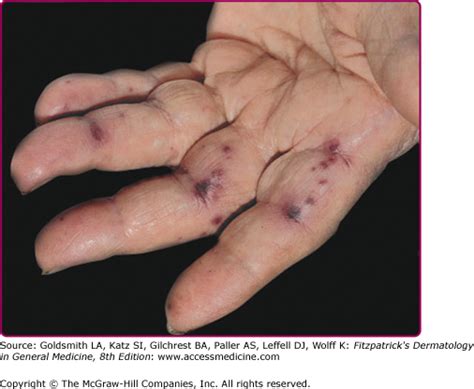 Finger, although patients who are immunocompromised may have a more indolent and chronic presentation, and a history of trauma in these patients may be remote or absent. The Skin in Infective Endocarditis, Sepsis, Septic Shock ...