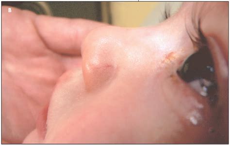 Once hereditary hemorrhagic telangiectasia is suspected, appropriate investigations and referrals can be made. Photoclinic: Hereditary Hemorrhagic Telangiectasia | Consultant360