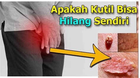 Namun pilihan yang tampaknya cerdas ini ternyata bisa memberikan dampak kesehatan yang serius. Apakah Kutil Bisa Hilang Sendiri - YouTube