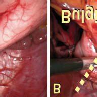 The prague classification was presented by an international research group in 2006 (1) and has since been regarded as the standard for measuring the length of barrett's esophagus. Left, short segment (C0, M1, by the Prague classification ...