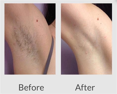 For about three weeks after a treatment, you may notice what looks like growing hair, but it is actually the treated hair falling out, or shedding. Laser Hair Removal - The Derm | Dermatologists in Cook ...