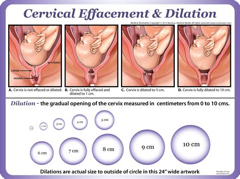 Check spelling or type a new query. Dilation and Cervical Effacement chart