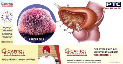 Bladder cancer begins when cells in the bladder develop changes (mutations) in their dna. Bladder Cancer: Overview, Symptoms, and Causes