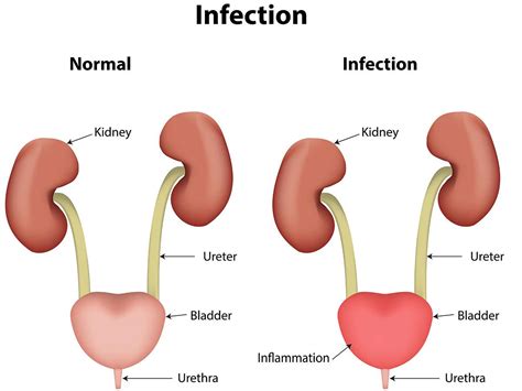 If the cancer has spread into or through the muscle layer of the bladder wall then treatment is less likely to be curative. Urinary Tract Infections (UTI) Melbourne | North Eastern ...