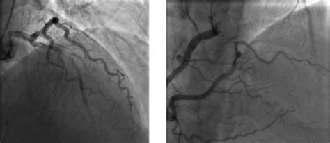 La trombosis es la formación de un coágulo en el interior de un vaso sanguíneo y uno de los causantes de un infarto agudo de miocardio. Trombosis "extremadamente" tardía de stent