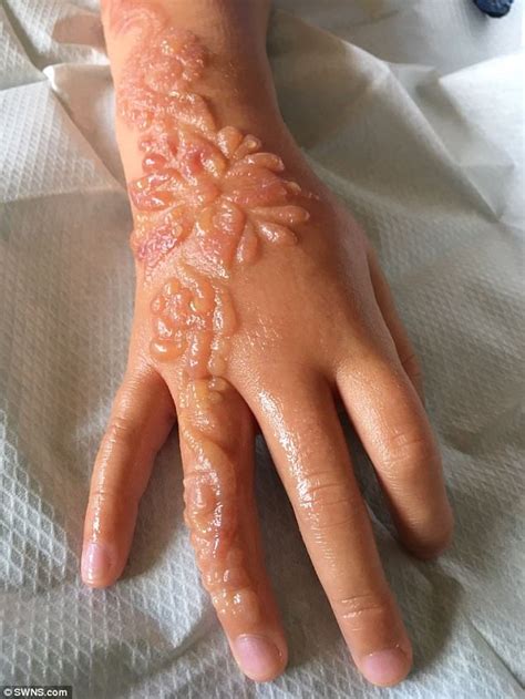 For those wanting the look of a tattoo without the permanence, a henna tattoo is a great way to enjoy temporary body art. 7 år gammel jente fikk kjemisk brannsår ved en ...