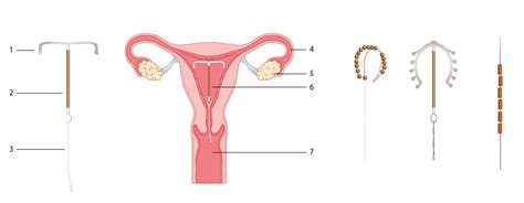 Das einsetzen der spirale beim frauenarzt. Die Spiralen sex-i.ch / sexual health info