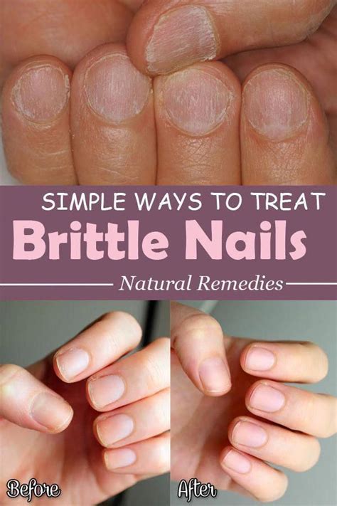 Why is my hair dry and brittle? Brittle nails are a problem for you? Not anymore with ...