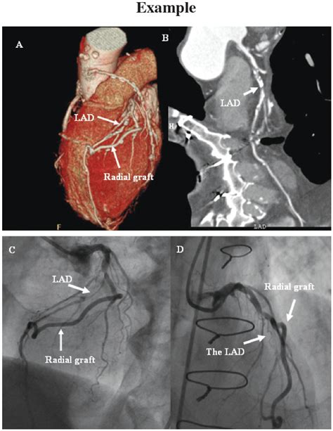 The smallest distance between two points in the object that can performed with a combined angiography and ct unite. Accuracy of the 256 Multi-detector Computerized Tomography ...