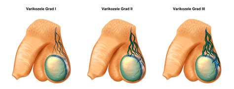 Nov 22, 2016 · eine varikozele ist eine erweiterung (krampfader) der venen in der haut des skrotums. Varikozele (Krampfader am Hoden) Ursachen und Therapie