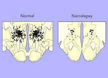 For example, patients with ih often sleep excessive amounts of time and have severe difficulty waking up after sleeping (i.e. The Science of Narcolepsy | Narcolepsy