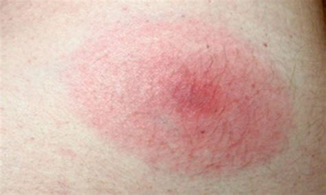 Fleas could be inhabitants of several types of viral. Flea Bites15