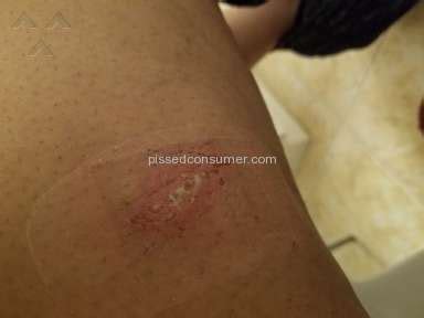 Although injuries do happen at home. Severe chemical burns from Nair Feb 17, 2019 @ Pissed Consumer