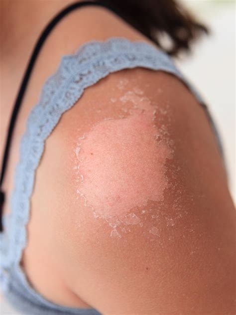 Redness, which is more apparent on light skin a warm or tight feeling Why Your Skin Peels After a Sunburn, According to ...
