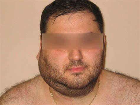 Диета при лимфоме не ходжкина УВЕЛИЧЕНИЕ ПЕРИФЕРИЧЕСКИХ УЗЛОВ ПРИ ЛИМФОМЕ ХОДЖКИНА И ДРУГИХ ЛИМФОМАХ УВЕЛИЧЕНИЕ ПЕРИФЕРИЧЕСКИХ УЗЛОВ ПРИ ЛИМФОМЕ ХОДЖКИНА И ДРУГИХ ЛИМФОМАХ Диета при лимфоме не ходжкина