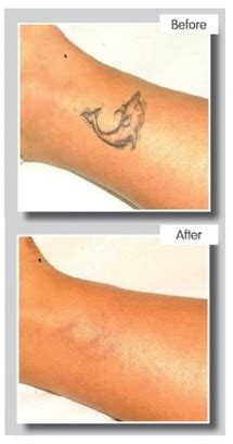 Beware of cheap imported models. Northampton tattoo removal | Skin Skills