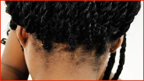 Many men wonder whether they need to pursue treatment to reverse the effects or if they can grow the hair back on their own. How To Grow Thinning Black Hair? What To Do For Thinning ...